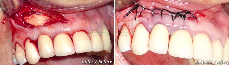 Retained teeth surgery
