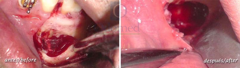 Cyst enucleation