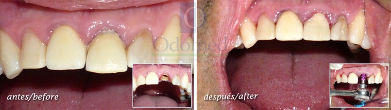 Post-extraction implant with provisional