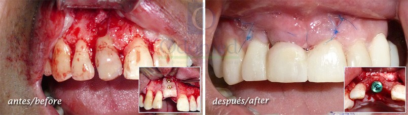 Surgery of soft tissue, bone and dental implant