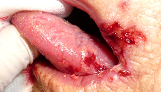 Ulcerative lesions