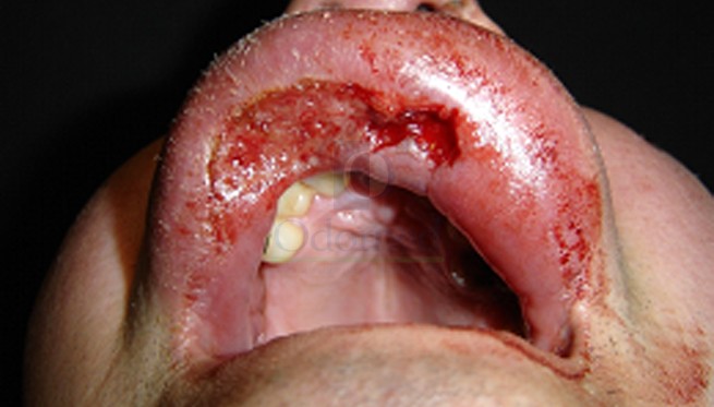 Ulcerative lesions
