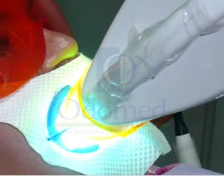 Teeth Whitening