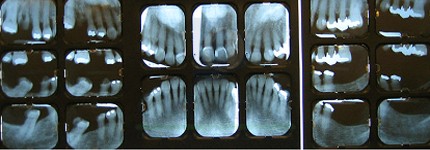 Periapical radiographs