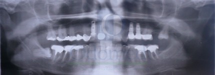 Panoramic X-Ray