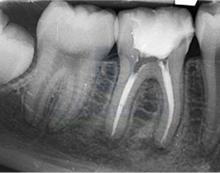 Root canal treatment