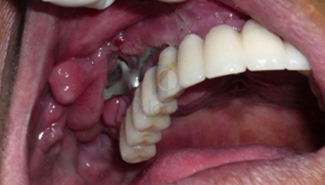 Patolog A Oral Costa Rica Cl Nica Dental Odomed Costa Rica
